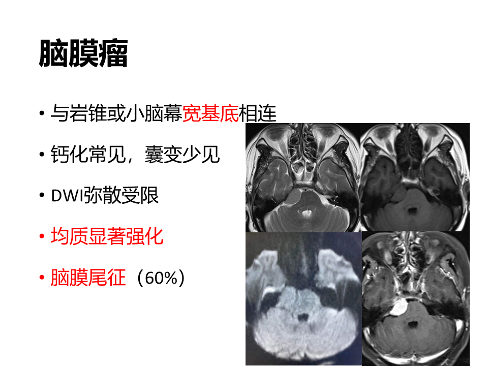 影像PPT - 【病例】桥小脑角区神经鞘瘤 VS 表皮样囊肿(胆脂瘤)-21