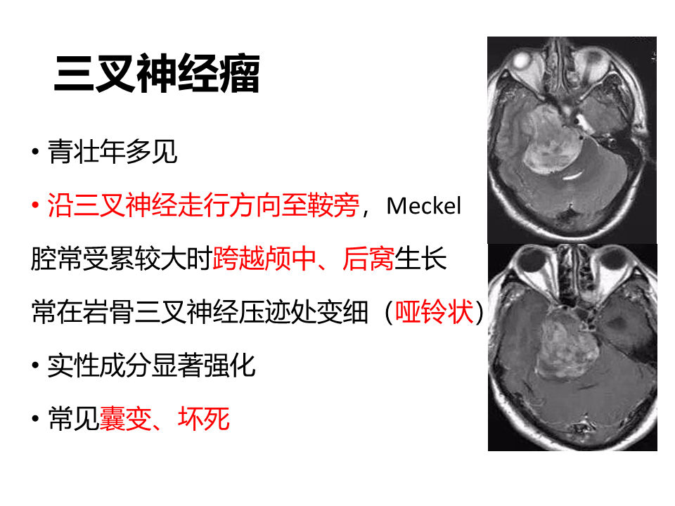 影像PPT - 【病例】桥小脑角区神经鞘瘤 VS 表皮样囊肿(胆脂瘤)-24