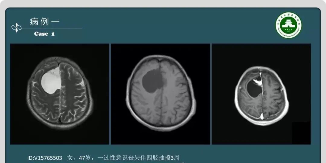 影像PPT - 【PPT】颅内囊性病变的影像学表现-2