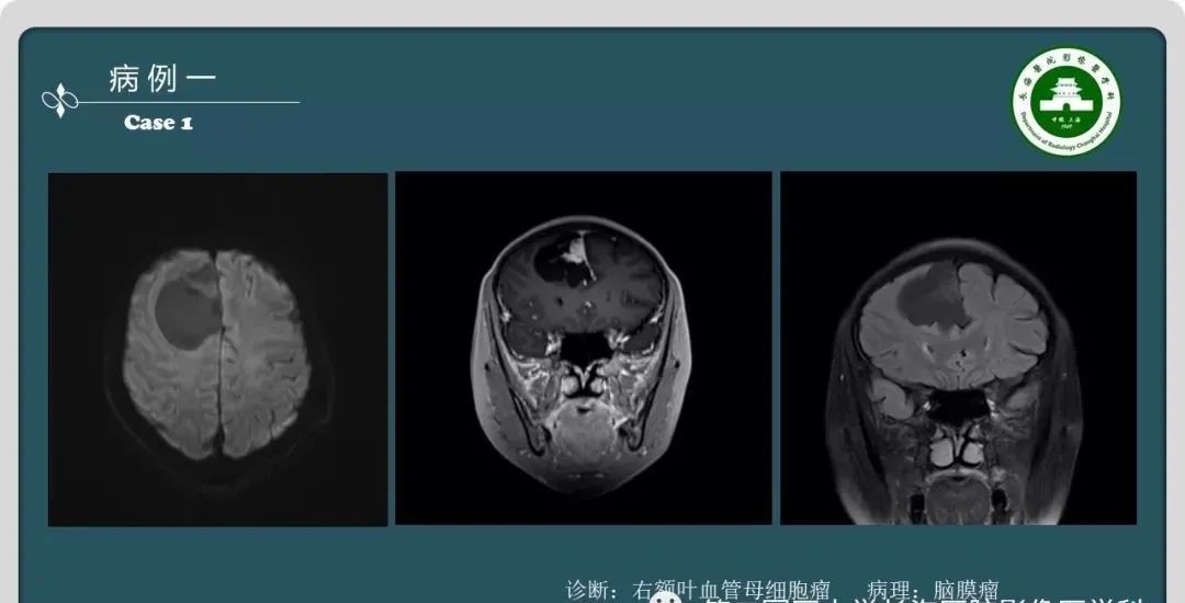 影像PPT - 【PPT】颅内囊性病变的影像学表现-3