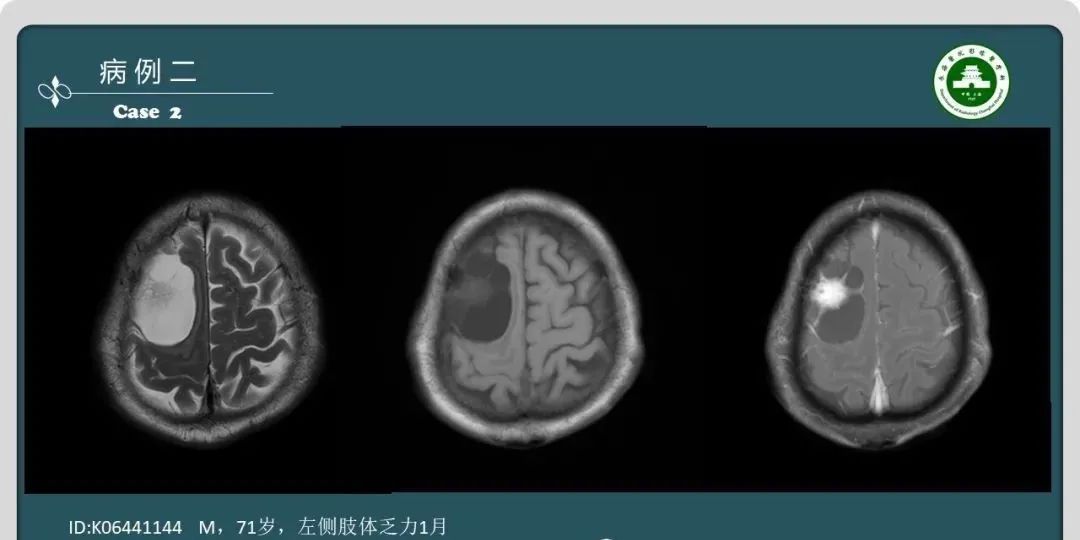 影像PPT - 【PPT】颅内囊性病变的影像学表现-4