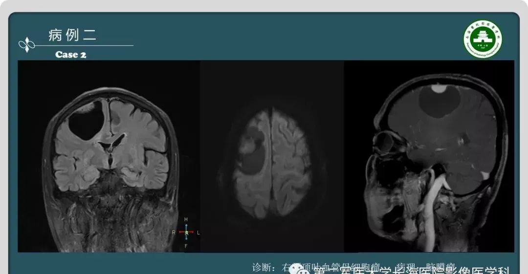 影像PPT - 【PPT】颅内囊性病变的影像学表现-5