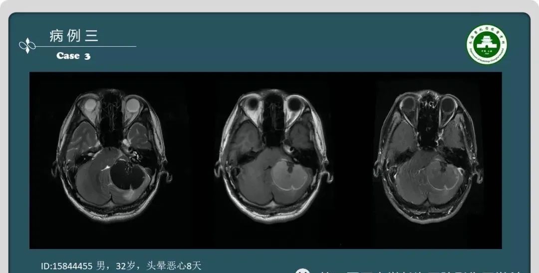 影像PPT - 【PPT】颅内囊性病变的影像学表现-6