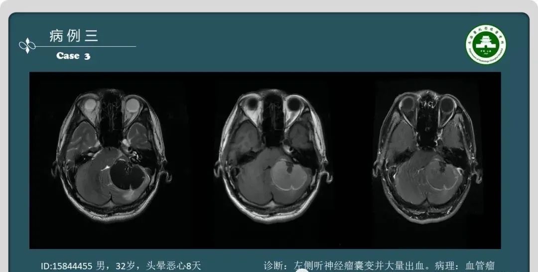 影像PPT - 【PPT】颅内囊性病变的影像学表现-7