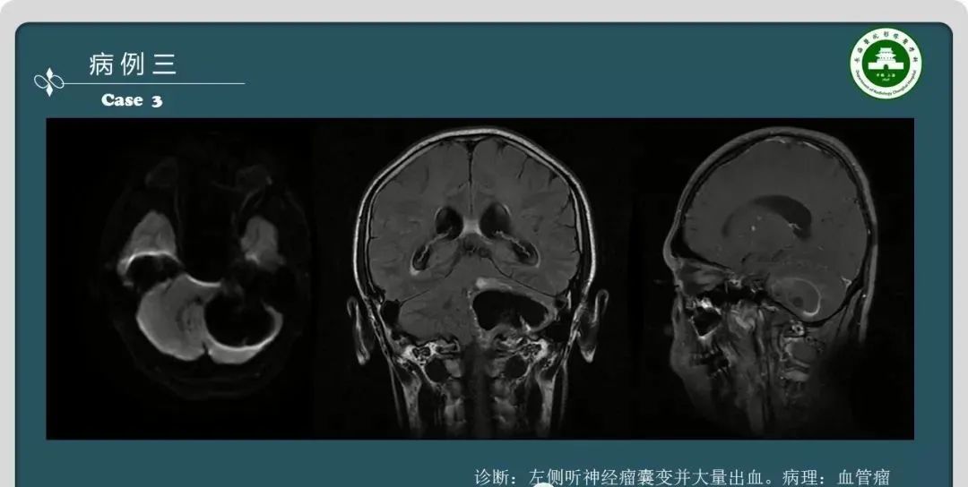 影像PPT - 【PPT】颅内囊性病变的影像学表现-8