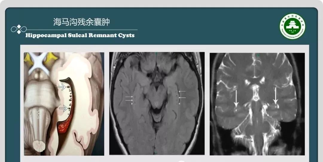 影像PPT - 【PPT】颅内囊性病变的影像学表现-20