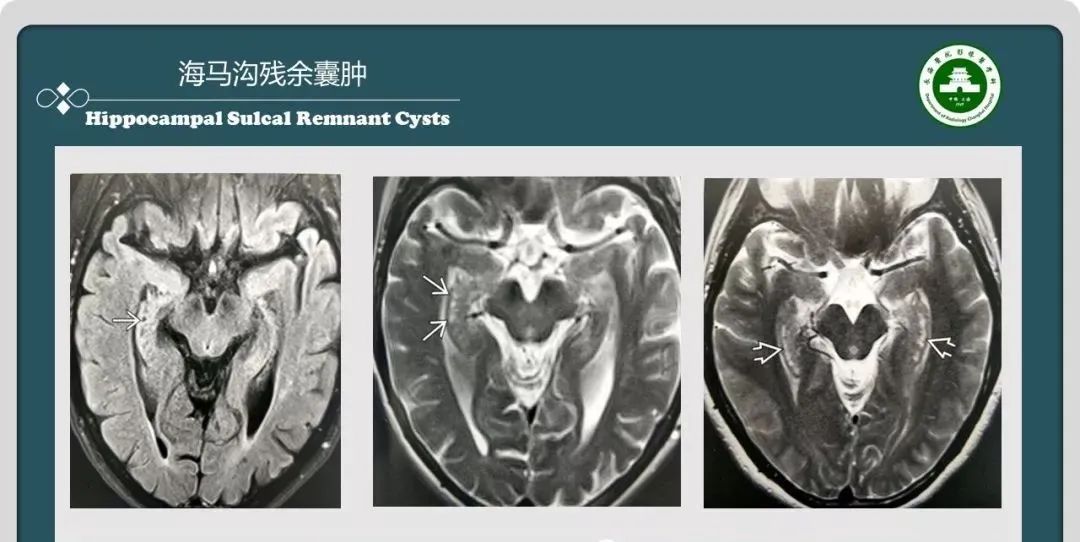 影像PPT - 【PPT】颅内囊性病变的影像学表现-21