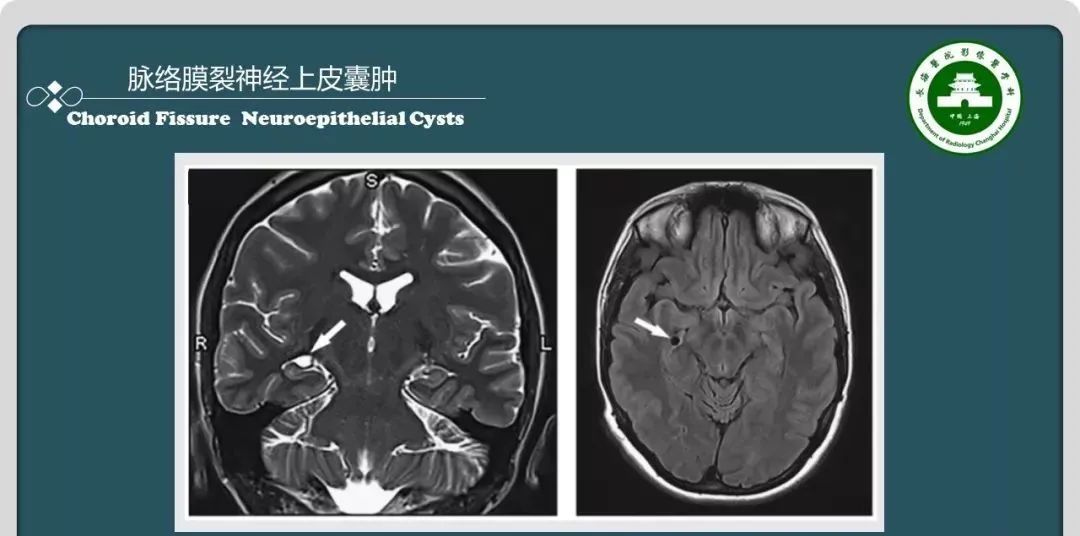 影像PPT - 【PPT】颅内囊性病变的影像学表现-26