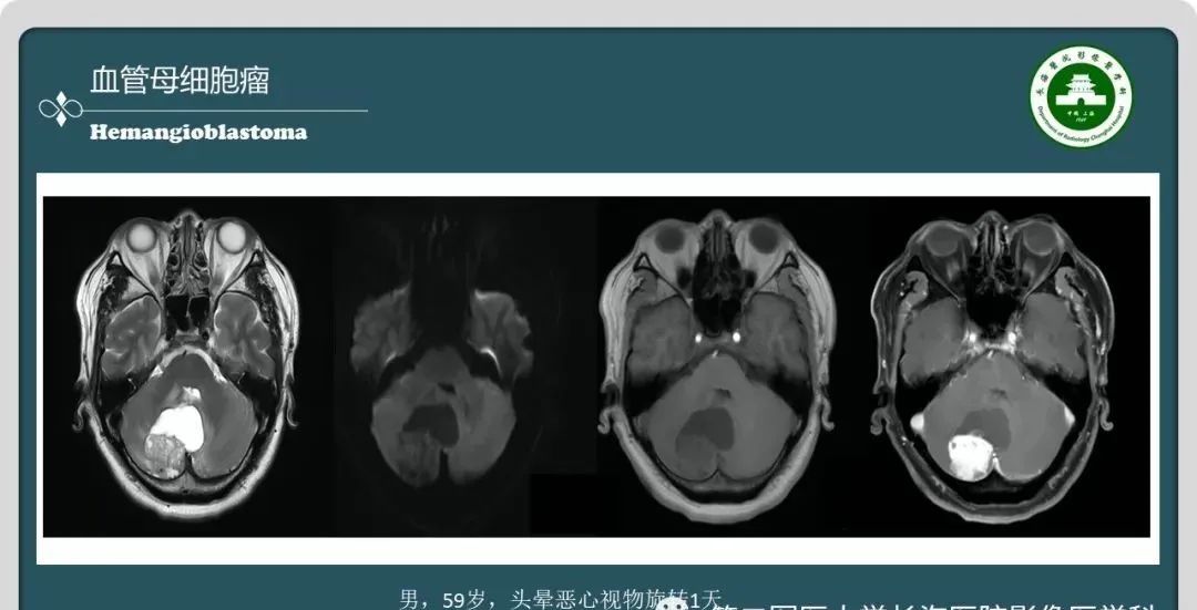 影像PPT - 【PPT】颅内囊性病变的影像学表现-37
