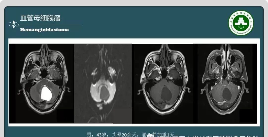 影像PPT - 【PPT】颅内囊性病变的影像学表现-38