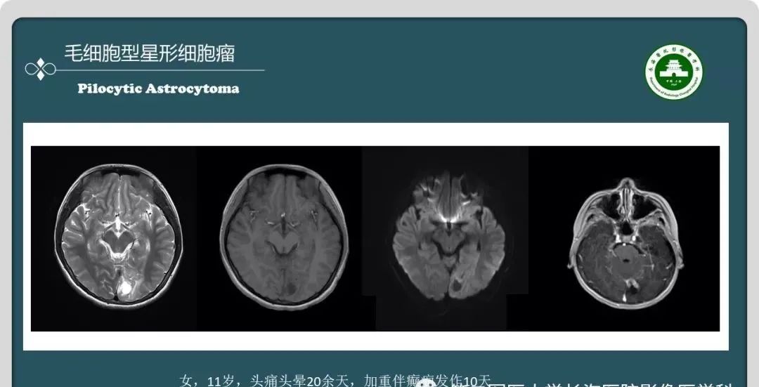 影像PPT - 【PPT】颅内囊性病变的影像学表现-41