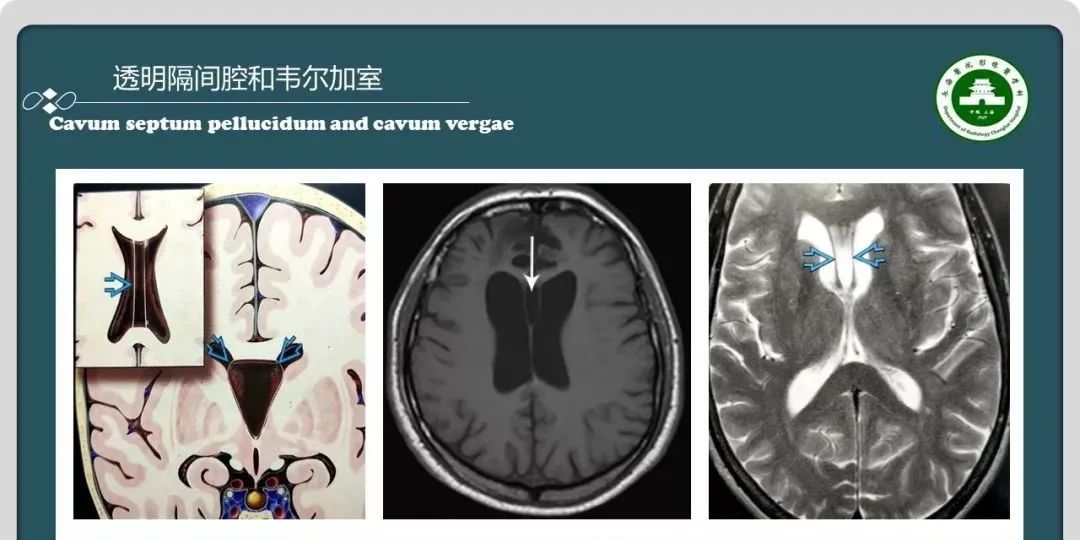 影像PPT - 【PPT】颅内囊性病变的影像学表现-59