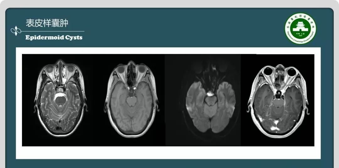 影像PPT - 【PPT】颅内囊性病变的影像学表现-86