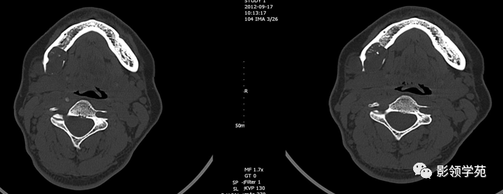 影像PPT - 颌骨囊性常见病变的CT诊断-4 影像PPT - 颌骨囊性常见病变的CT诊断-4