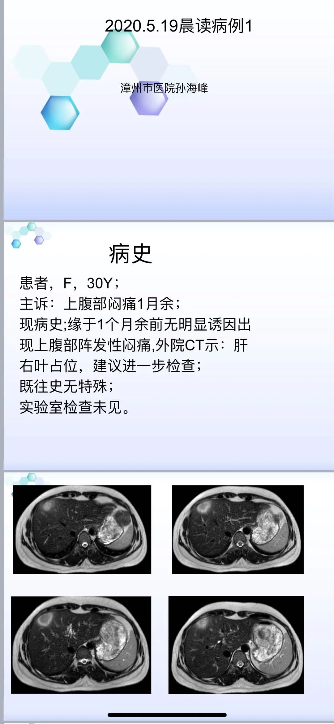 影像PPT - 【病例】肝脏肉芽肿性炎1例CT及MR影像-1