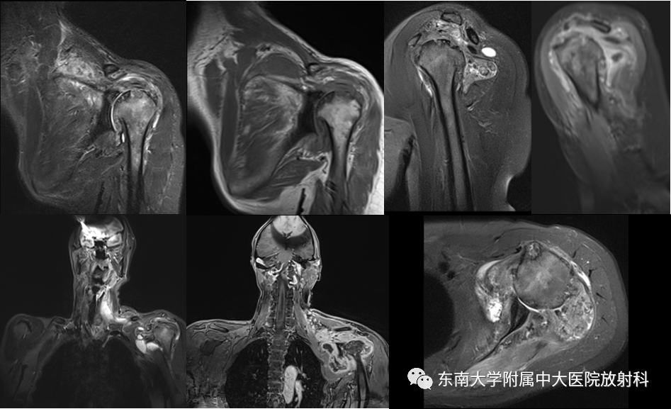 影像PPT - 【病例】慢性肩关节炎1例CT及MR影像-3