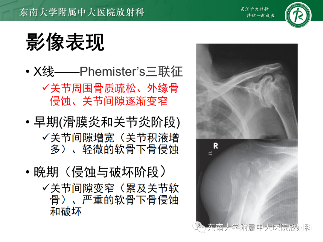 影像PPT - 【病例】慢性肩关节炎1例CT及MR影像-9