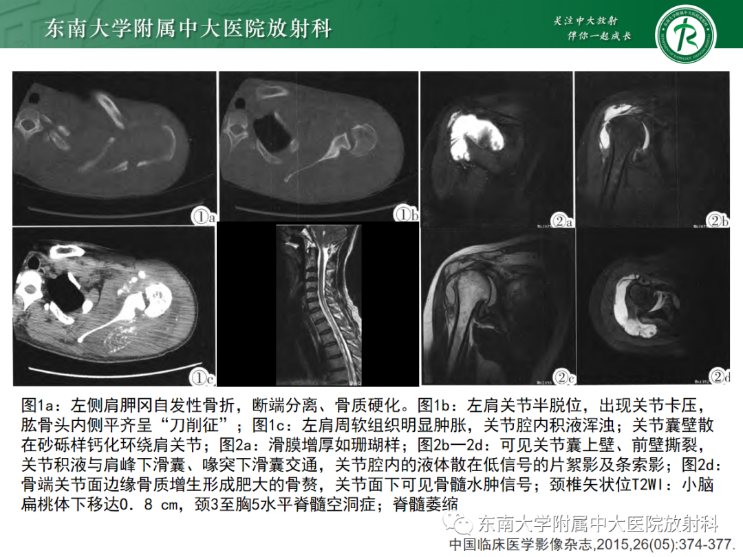 影像PPT - 【病例】慢性肩关节炎1例CT及MR影像-14