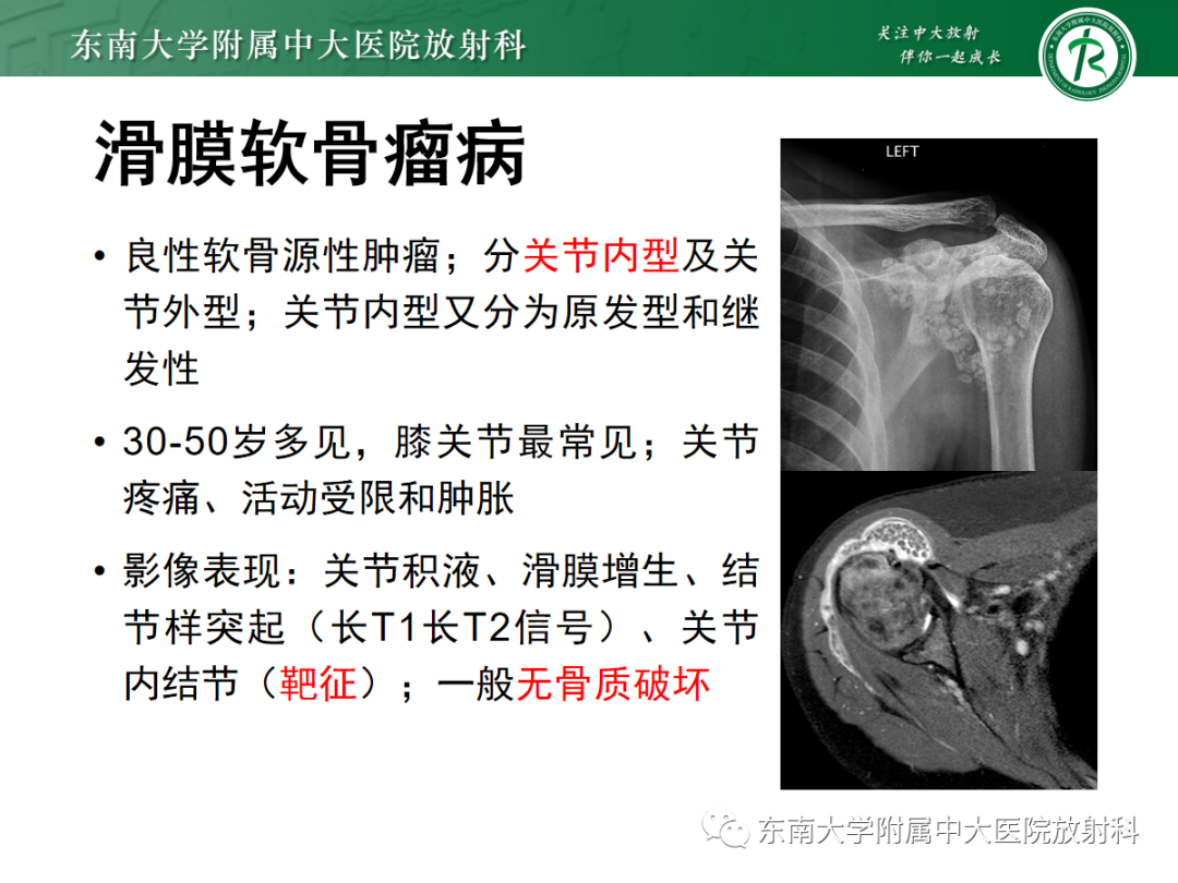 影像PPT - 【病例】慢性肩关节炎1例CT及MR影像-16