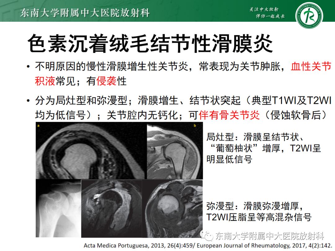 影像PPT - 【病例】慢性肩关节炎1例CT及MR影像-17