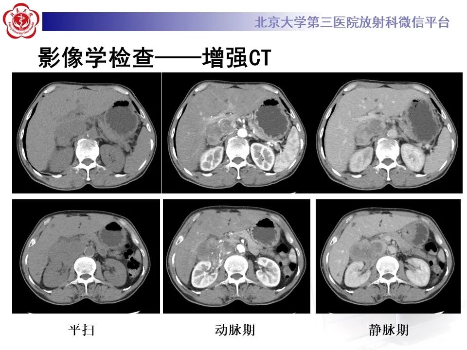 影像PPT - 【PPT】腹膜后平滑肌肉瘤的影像-3