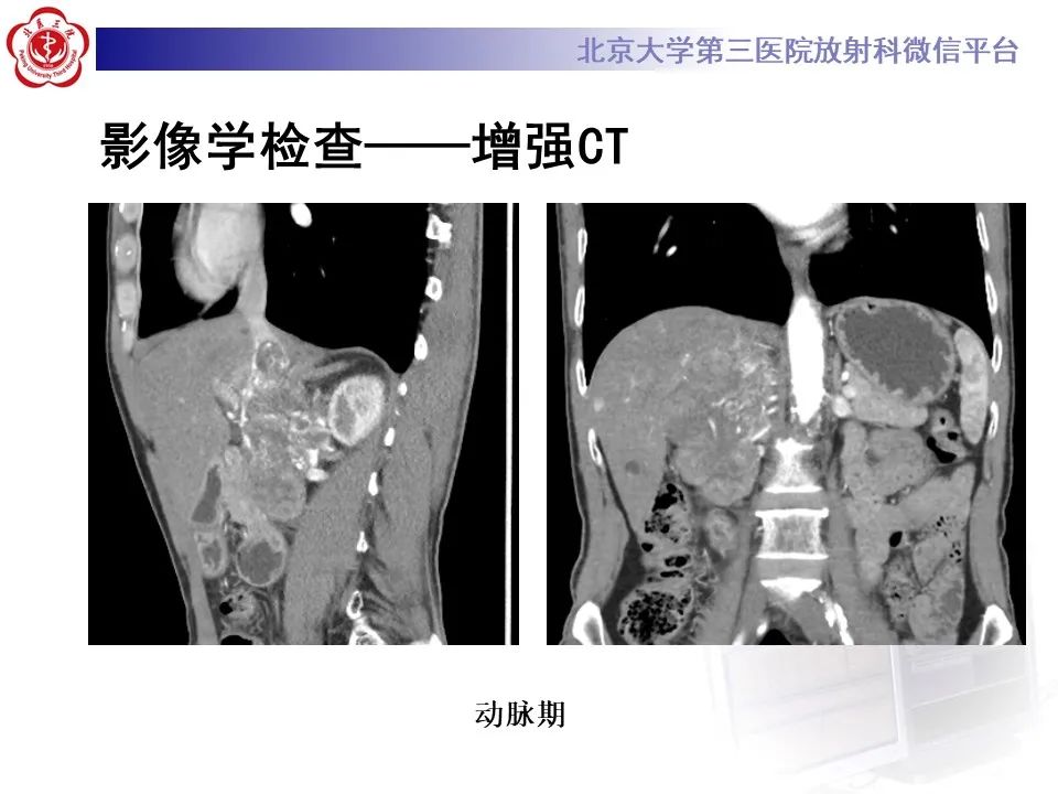 影像PPT - 【PPT】腹膜后平滑肌肉瘤的影像-4