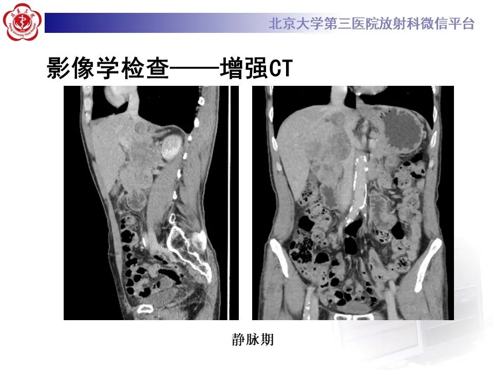 影像PPT - 【PPT】腹膜后平滑肌肉瘤的影像-5