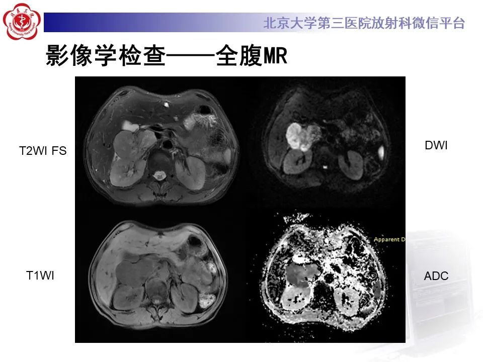 影像PPT - 【PPT】腹膜后平滑肌肉瘤的影像-7