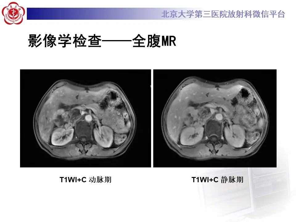 影像PPT - 【PPT】腹膜后平滑肌肉瘤的影像-8