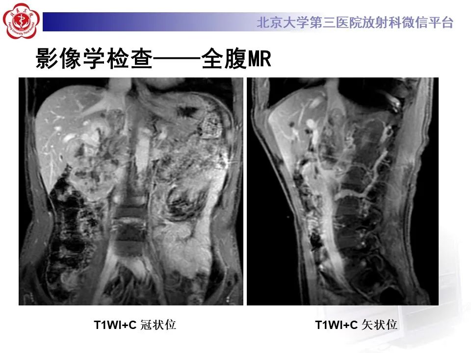 影像PPT - 【PPT】腹膜后平滑肌肉瘤的影像-9