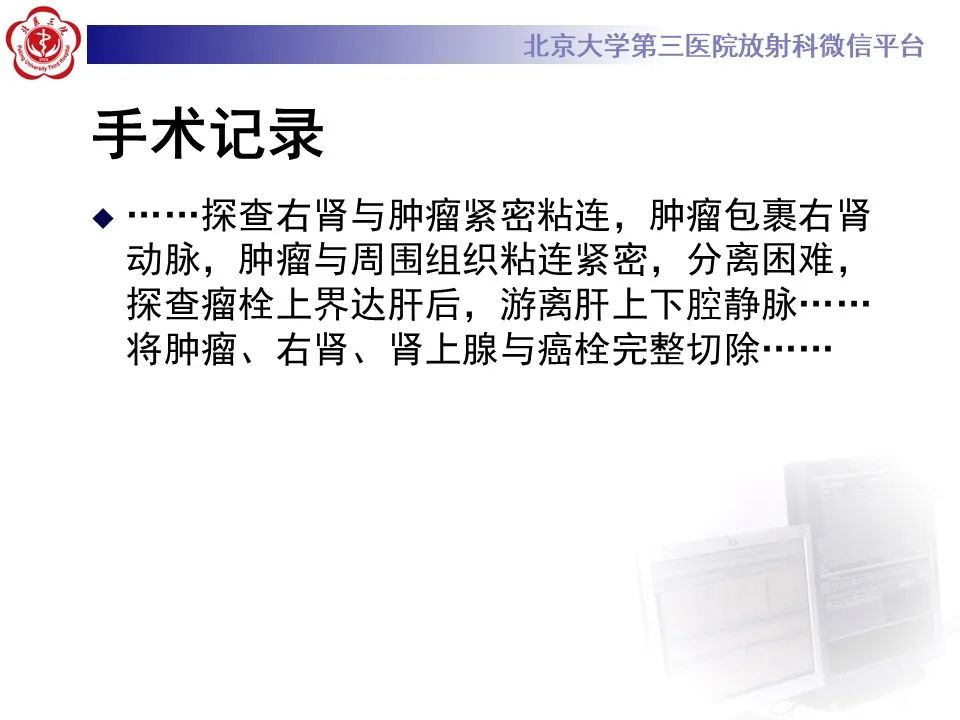 影像PPT - 【PPT】腹膜后平滑肌肉瘤的影像-13