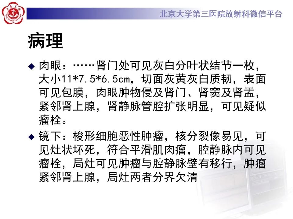 影像PPT - 【PPT】腹膜后平滑肌肉瘤的影像-14