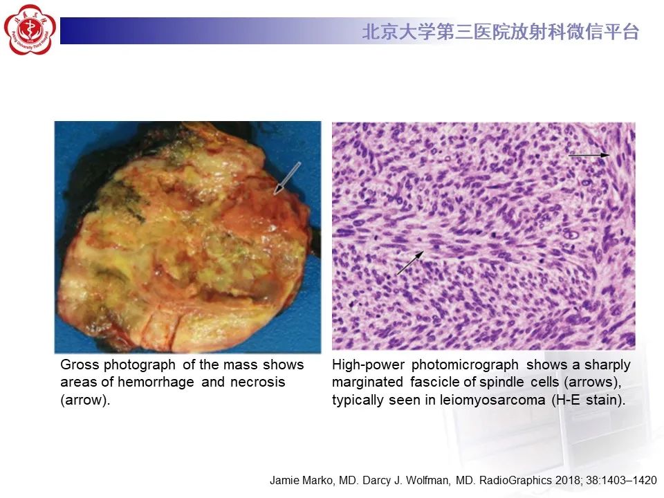影像PPT - 【PPT】腹膜后平滑肌肉瘤的影像-19