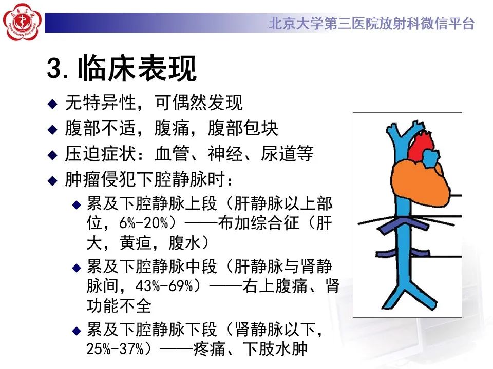 影像PPT - 【PPT】腹膜后平滑肌肉瘤的影像-20