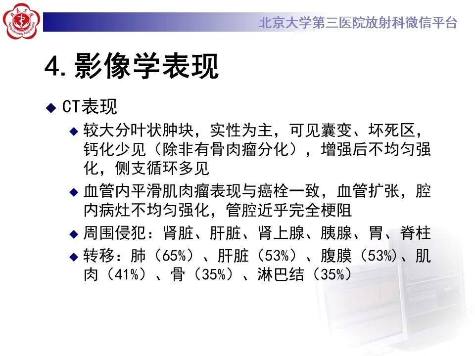 影像PPT - 【PPT】腹膜后平滑肌肉瘤的影像-21