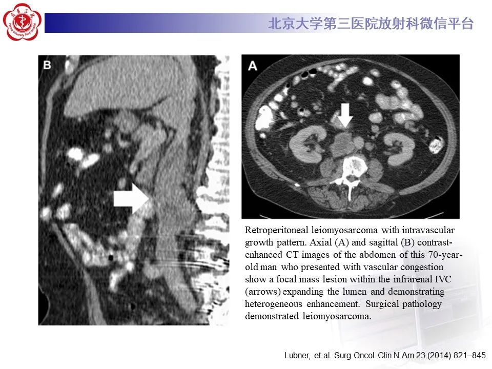 影像PPT - 【PPT】腹膜后平滑肌肉瘤的影像-23