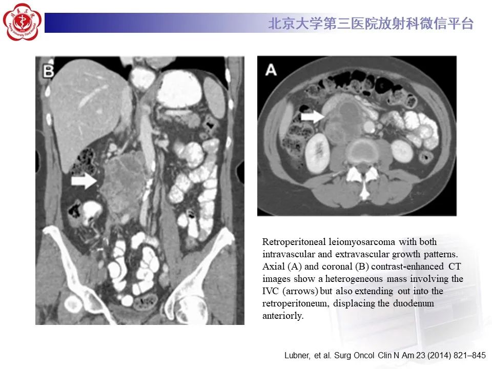 影像PPT - 【PPT】腹膜后平滑肌肉瘤的影像-24