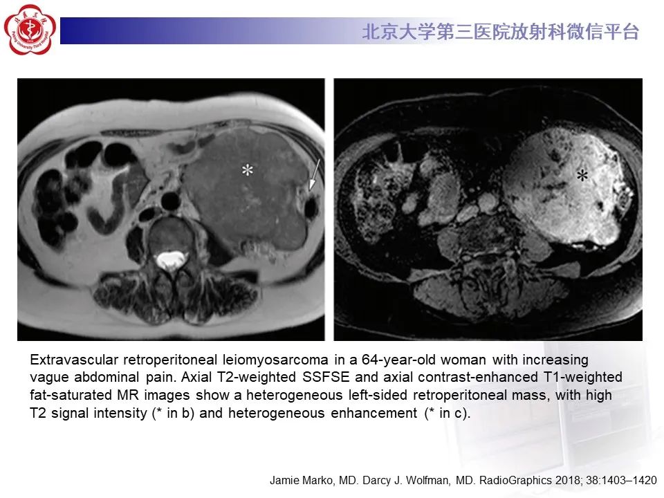 影像PPT - 【PPT】腹膜后平滑肌肉瘤的影像-27