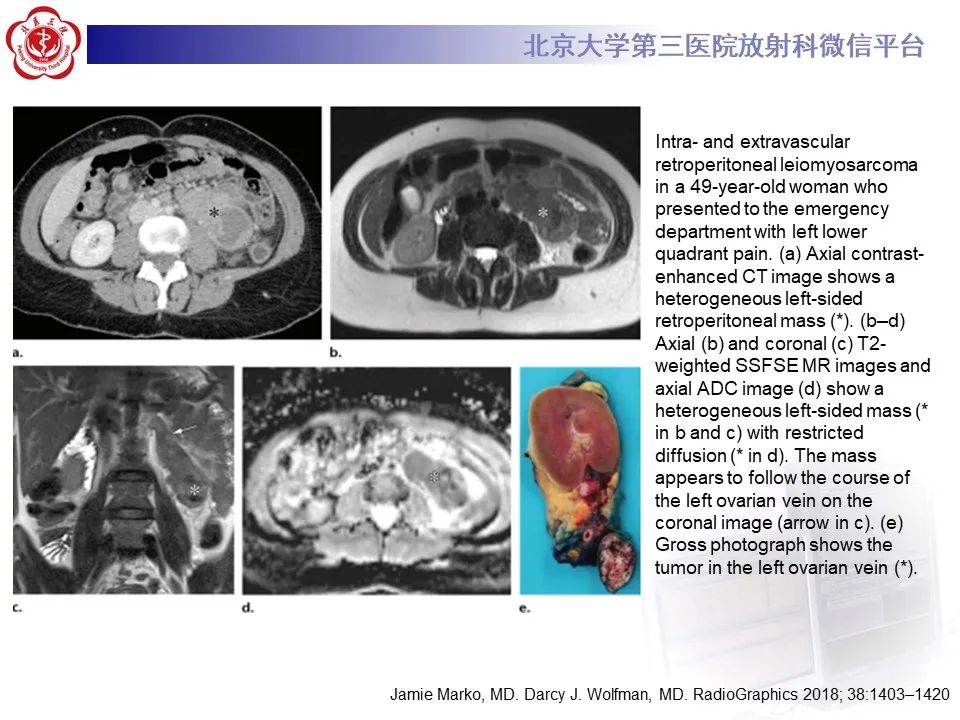 影像PPT - 【PPT】腹膜后平滑肌肉瘤的影像-28