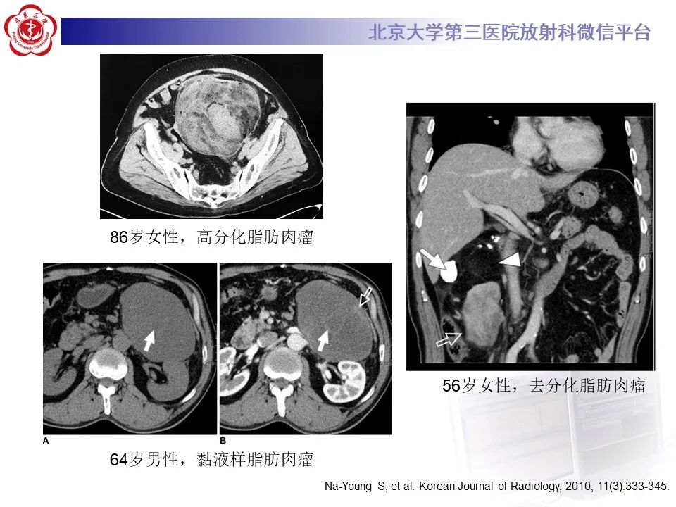 影像PPT - 【PPT】腹膜后平滑肌肉瘤的影像-32