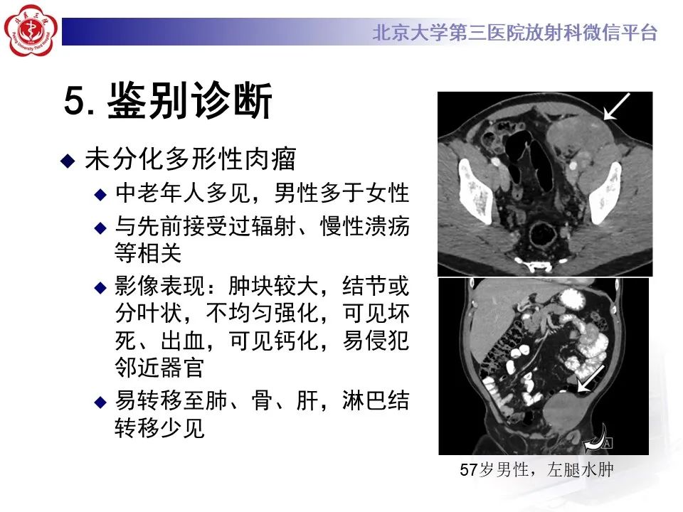 影像PPT - 【PPT】腹膜后平滑肌肉瘤的影像-33