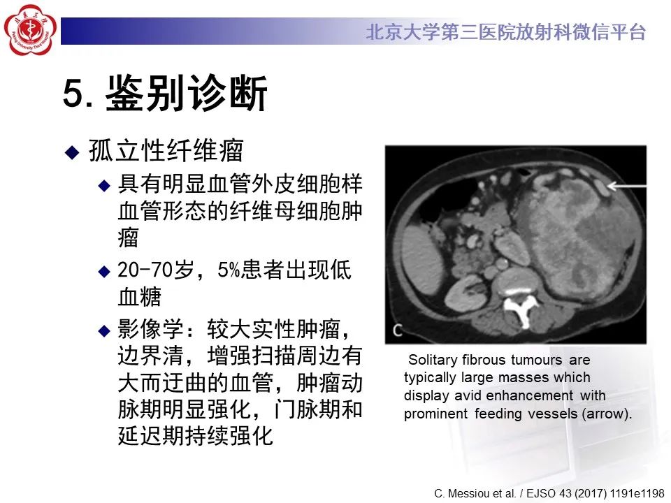 影像PPT - 【PPT】腹膜后平滑肌肉瘤的影像-34