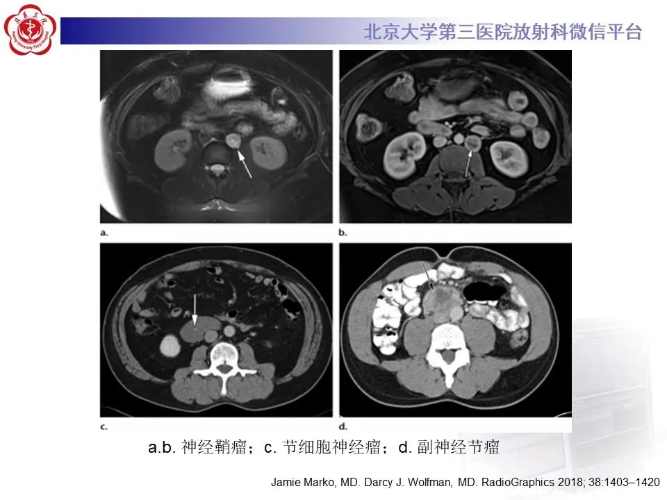 影像PPT - 【PPT】腹膜后平滑肌肉瘤的影像-36