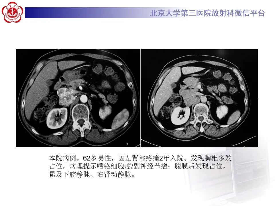 影像PPT - 【PPT】腹膜后平滑肌肉瘤的影像-37
