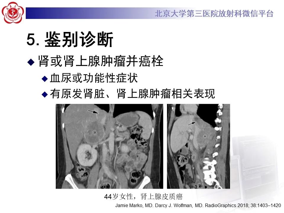 影像PPT - 【PPT】腹膜后平滑肌肉瘤的影像-39