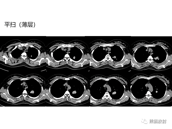 影像PPT - 【病例】支气管扩张并感染VS微浸润性腺癌-5
