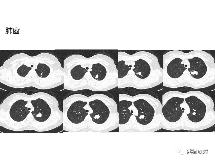 影像PPT - 【病例】支气管扩张并感染VS微浸润性腺癌-8