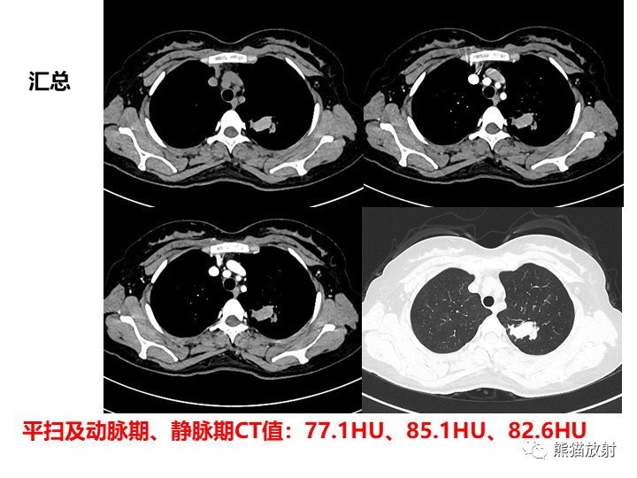 影像PPT - 【病例】支气管扩张并感染VS微浸润性腺癌-9