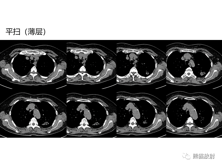 影像PPT - 【病例】支气管扩张并感染VS微浸润性腺癌-13
