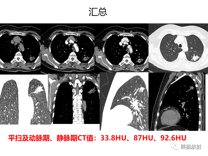 影像PPT - 【病例】支气管扩张并感染VS微浸润性腺癌-21